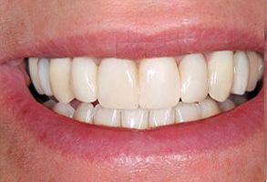Precision Dental of Westminster | Dental Bridges, Emergency Treatment and Root Canals