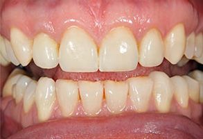 Precision Dental of Westminster | Invisalign reg , Periodontal Treatment and Dental Bridges