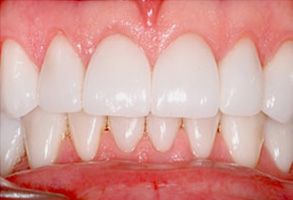 Precision Dental of Westminster | Dental Cleanings, Crowns  amp  Caps and Sedation Dentistry