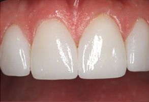 Precision Dental of Westminster | Implant Restorations, Implant Dentistry and Periodontal Treatment