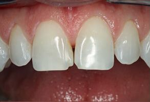 Precision Dental of Westminster | Night Guards, Periodontal Treatment and Dental Bridges